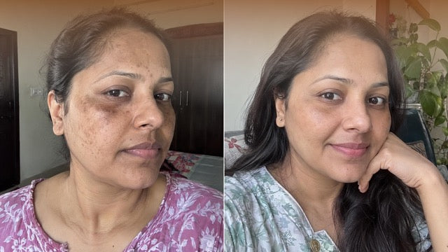 🌸 Melasma and dark patches