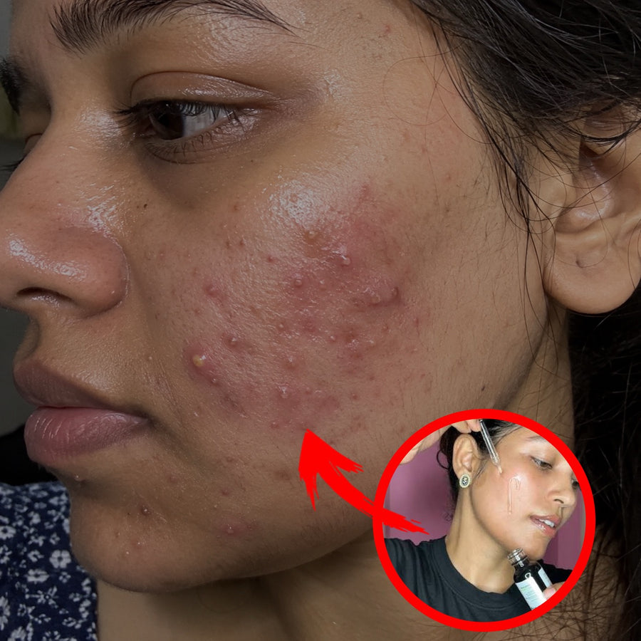 High-strength acid serum
